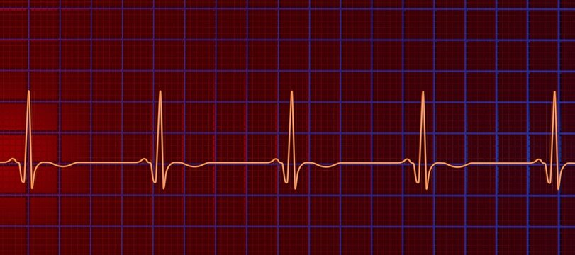 Chronic Q wave ECG, 3D illustration, electrocardiogram pattern showing persistent pathological Q wave and chronic myocardial scar after infarction.