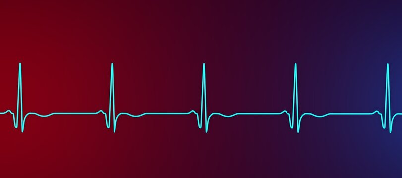 Chronic Q wave ECG, 3D illustration, electrocardiogram pattern showing persistent pathological Q wave and chronic myocardial scar after infarction.