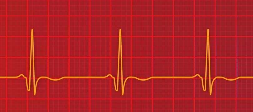 Chronic Q wave ECG, 3D illustration, electrocardiogram pattern showing persistent pathological Q wave and chronic myocardial scar after infarction.