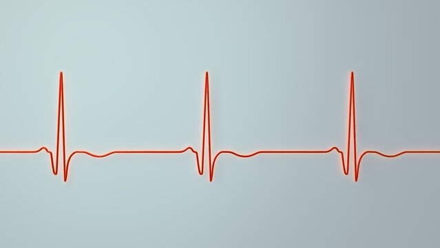 Chronic Q wave ECG, 3D illustration, electrocardiogram pattern showing persistent pathological Q wave and chronic myocardial scar after infarction.