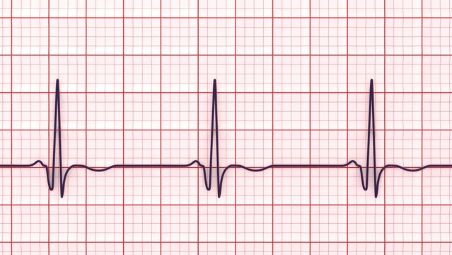 Chronic Q wave ECG, 3D illustration, electrocardiogram pattern showing persistent pathological Q wave and chronic myocardial scar after infarction.