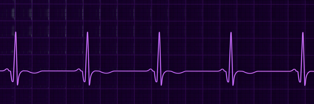 Chronic Q wave ECG, 3D illustration, electrocardiogram pattern showing persistent pathological Q wave and chronic myocardial scar after infarction.