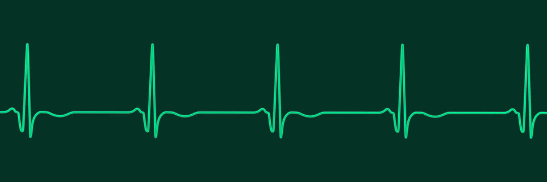 Chronic Q wave ECG, 3D illustration, electrocardiogram pattern showing persistent pathological Q wave and chronic myocardial scar after infarction.