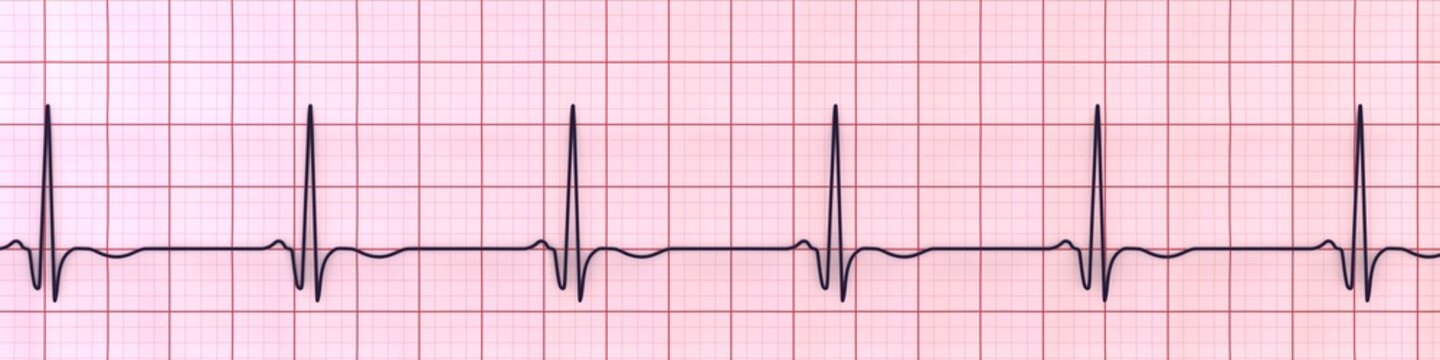 Chronic Q wave ECG, 3D illustration, electrocardiogram pattern showing persistent pathological Q wave and chronic myocardial scar after infarction.