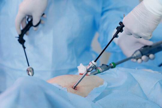 Surgeons inserting trocars during laparoscopic surgery in operating room