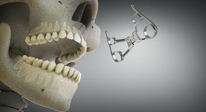 Orthodontic Appliance-RPE (Rapid Palatal Expander) in 3D