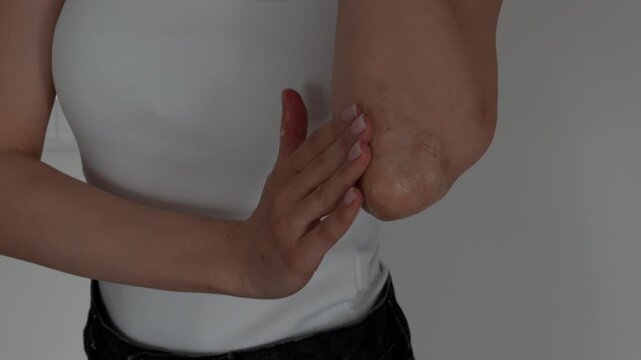 Close-up of woman applying healing ointment on psoriasis affected skin