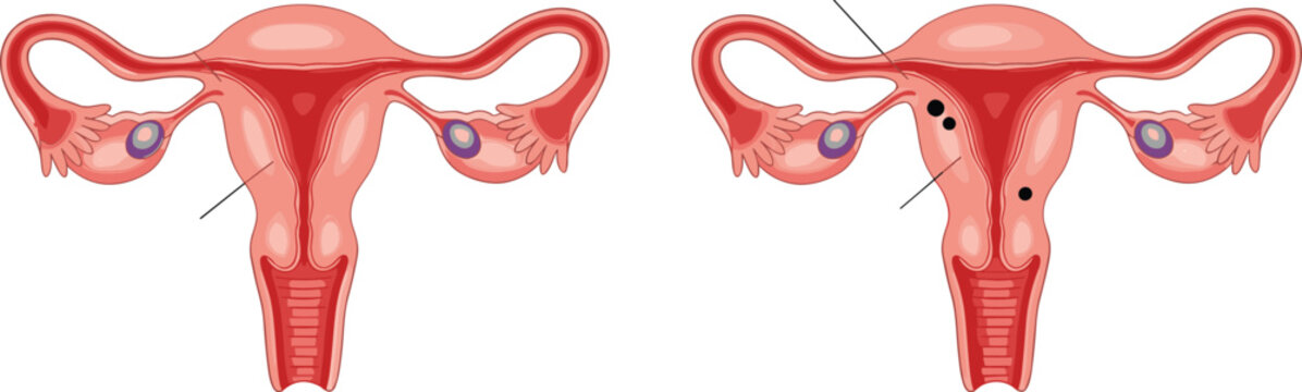 Female reproductive system uterus anatomy comparison vector showing healthy uterus and abnormal uterus with endometriosis or fibroids for gynecology education