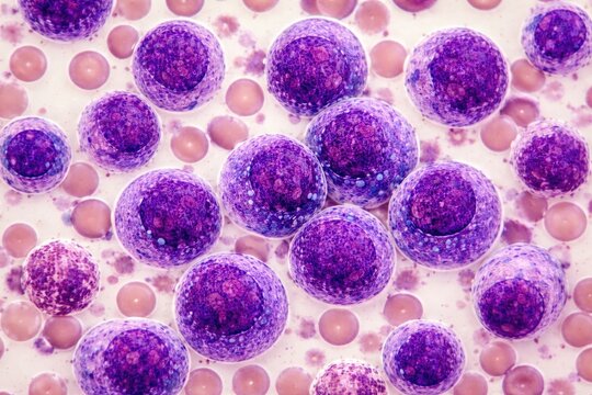 Diagnostic view of blood smear showing blast cells in acute myeloid leukemia