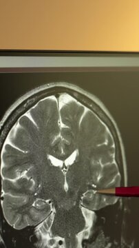 A brain MRI displayed on a screen, showing a coronal T2-weighted slice. A hand holding a pen points to the hippocampal region, illustrating neuroanatomy and memory-related structures