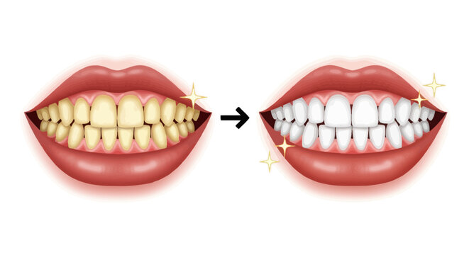 Stunning before and after comparison showcasing the impressive results of advanced teeth whitening procedures, revealing a bright, confident smile