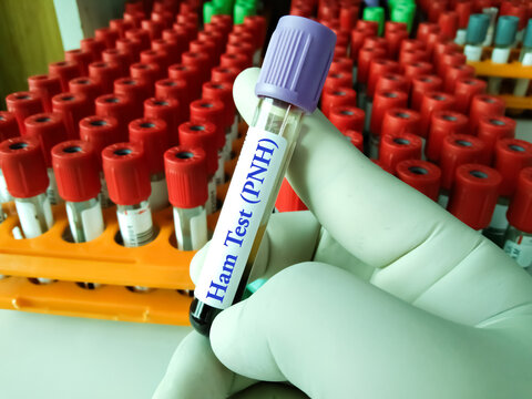 Blood sample for Measles or Rubella test. To diagnose paroxysmal nocturnal hemoglobinuria (PNH),