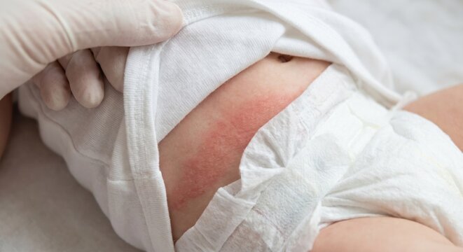Baby with skin irritation from diaper on waistline