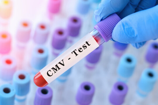Doctor holding CMV blood test tube explaining detection of cytomegalovirus infection, immune response evaluation and viral diagnostics in clinical laboratory testing