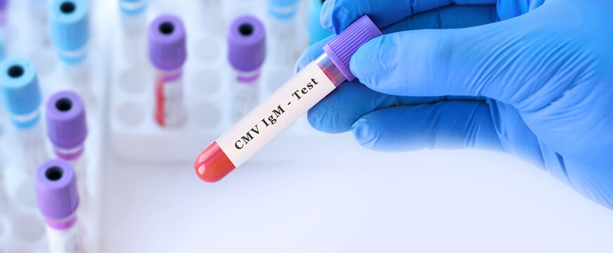 Doctor holding CMV blood test tube explaining detection of cytomegalovirus infection, immune response evaluation and viral diagnostics in clinical laboratory testing