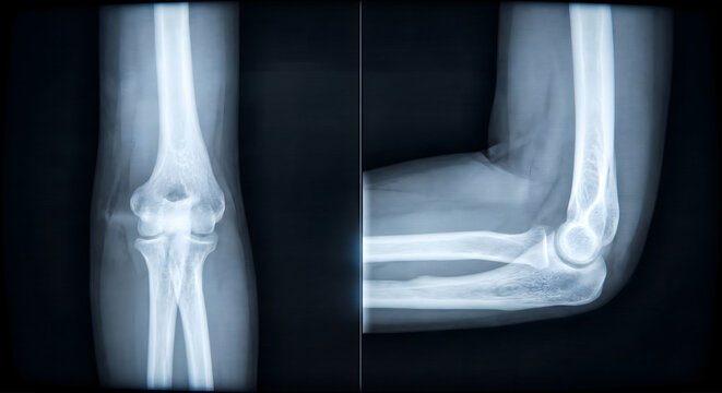 肘関節の構造を示す腕のレントゲン画像の正面と側面（屈曲状態）イメージ
