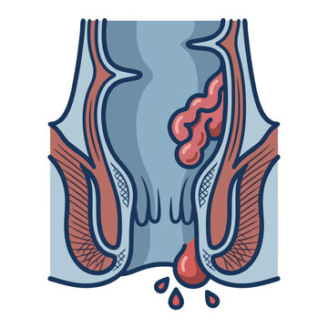 Hemorrhoids Piles and Rectal Bleeding Medical Illustration