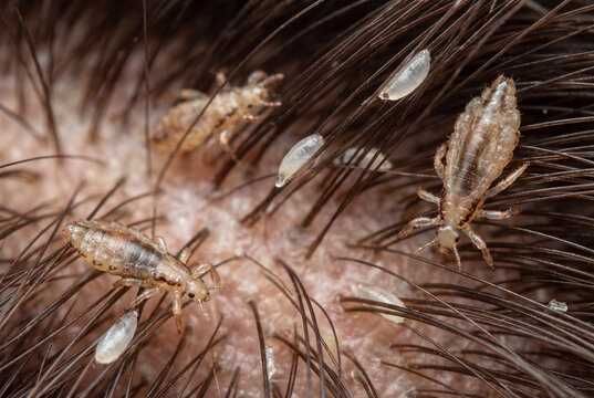 Macro view of head lice and nits in dark human hair