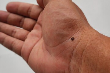 Naklejka premium Close-up of dark mole on human palm wrist skin