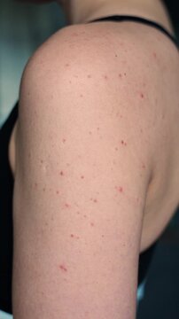 Hormonal acne on shoulder skin in adult woman. Skin problems and body changes due to hormonal imbalance concept.