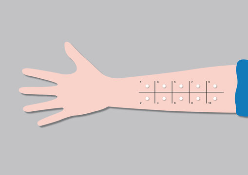 Allergy testing, illustration