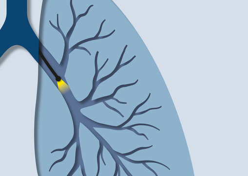 Bronchoscopy, conceptual illustration