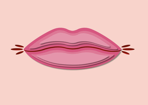 Cracked lips, conceptual illustration