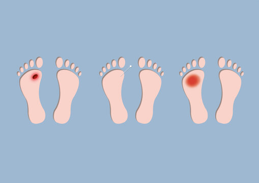 Foot ulcers, conceptual illustration