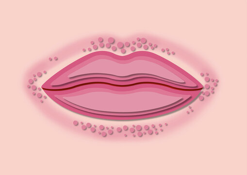Lip licker's dermatitis, conceptual illustration