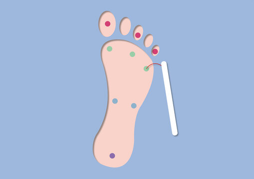 Monofilament test, conceptual illustration