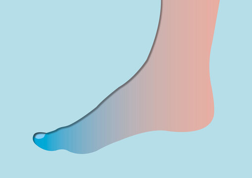 Raynaud's syndrome, conceptual illustration