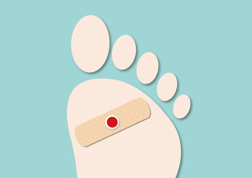 Plantar wart treatment, conceptual illustration