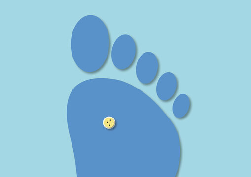 Plantar wart, conceptual illustration