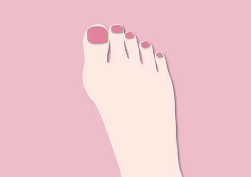 Bunion, illustration
