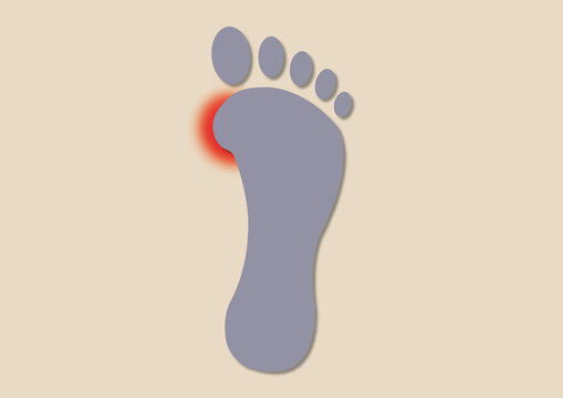 Bunion, conceptual illustration