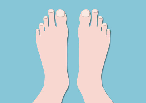 Morton's toe, illustration