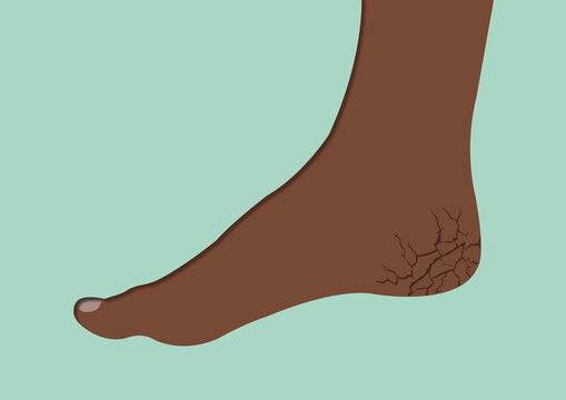 Cracked heel, conceptual illustration