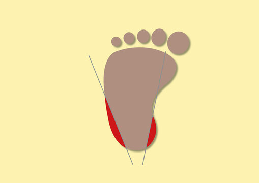 Heel prick test, conceptual illustration