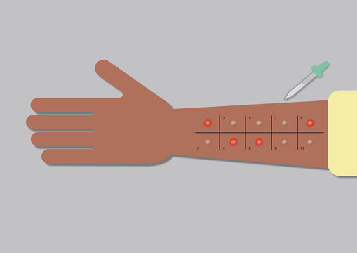 Allergy testing, illustration