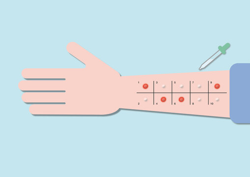 Allergy testing, illustration