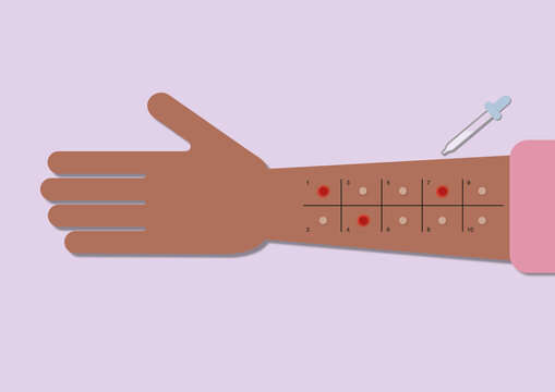 Allergy testing, illustration