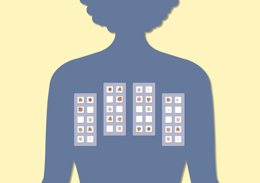 Allergy testing, illustration