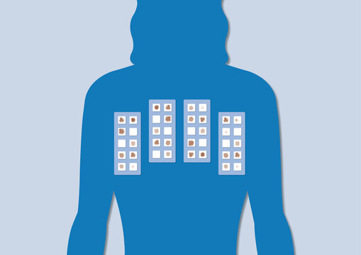 Allergy testing, illustration