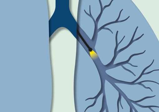 Bronchoscopy, conceptual illustration