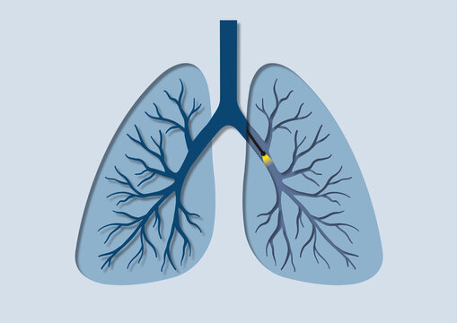 Bronchoscopy, conceptual illustration