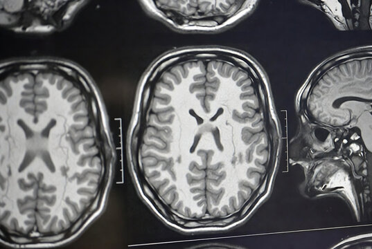 Brain MRI scans revealing white matter abnormalities and potential signs of a ventricular enlargement.