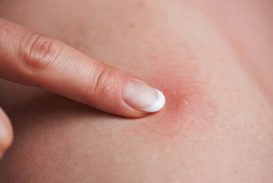 A hand is scratching an area of irritated, inflamed skin. It appears to be a close-up of someone&rsquo;s back.