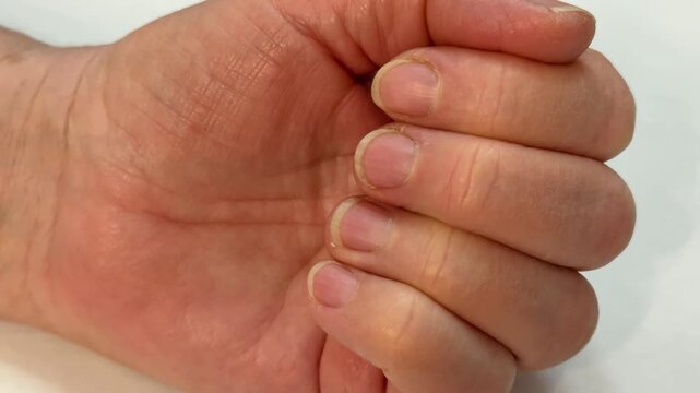 Elderly Woman's Hands Closeup Showing Long Uncut Nails, Pale Skin With Visible Wrinkles, Dry Cuticles And Natural Texture Intimate Clinical Composition Conveying Fragility And Neglect Soft.