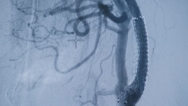Fluoroscopic tracking shot of carotid artery with stent and catheter deploying in carotid cerebral angiogram in interventional suite.