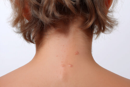 Close up acne on upper back and nape with scattered inflamed spots and raised papules showing irritated skin